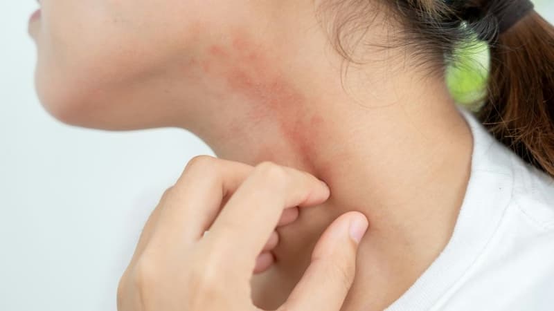 Mẩn ngứa khắp người là dấu hiệu bệnh gì và xử lý thế nào