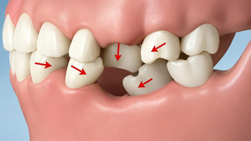 Bị mất 1 răng hàm có sao không và các phương pháp phục hình