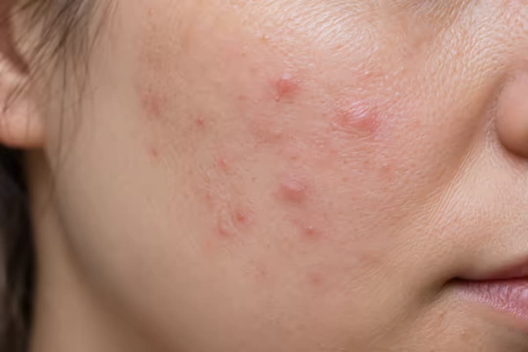 Mụn dị ứng là gì và cách phân biệt với mụn thông thường