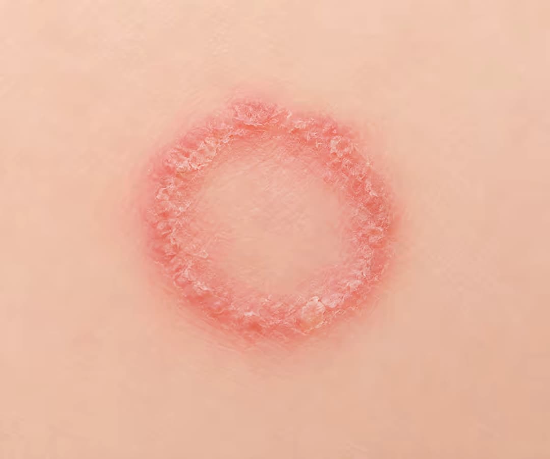 Chăm sóc và xử trí nấm da ở trẻ sơ sinh an toàn đúng cách