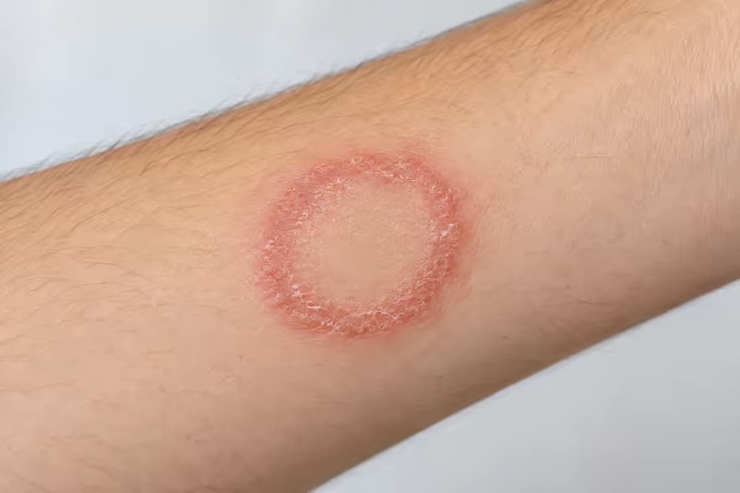 Bệnh nấm Dermatophytosis: Nguyên nhân, triệu chứng và cách phòng ngừa