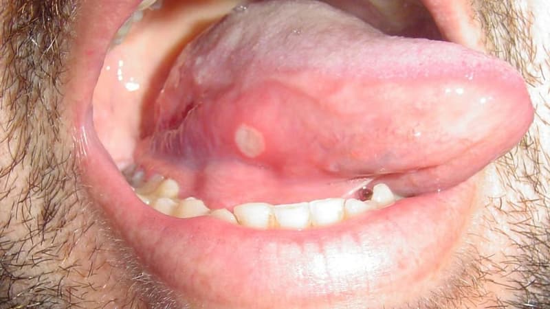 Nhiệt miệng dưới lưỡi: Nguyên nhân, biểu hiện và cách chăm sóc