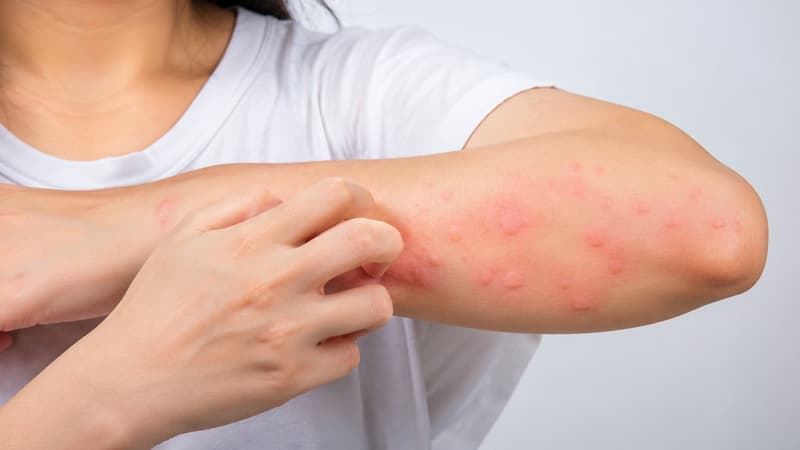 Nổi mề đay: Biểu hiện, nguyên nhân và cách chăm sóc da
