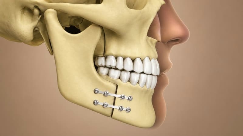 Phẫu thuật khớp cắn ngược: Chỉ định, quy trình thực hiện và những lưu ý quan trọng