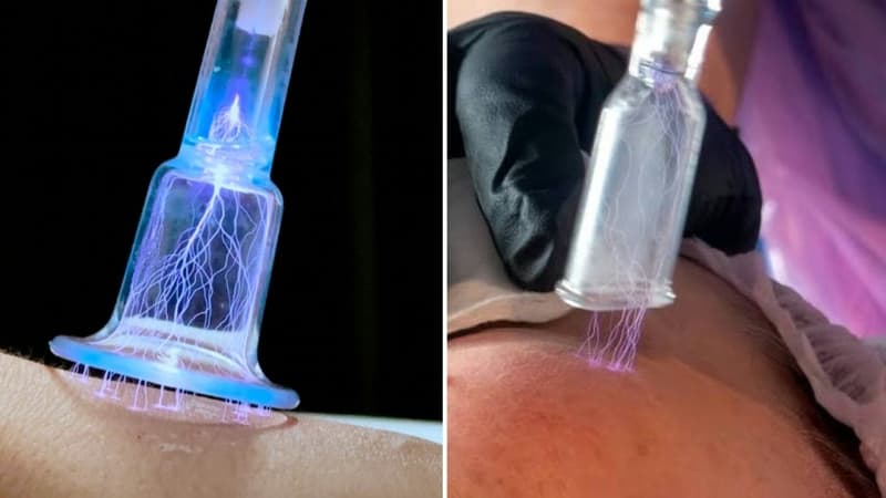 Công nghệ plasma lạnh và ứng dụng trong y học hiện đại