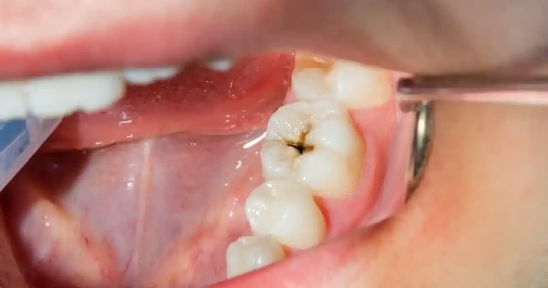 Nhổ răng cấm có đau không và các trường hợp tạm hoãn cần lưu ý