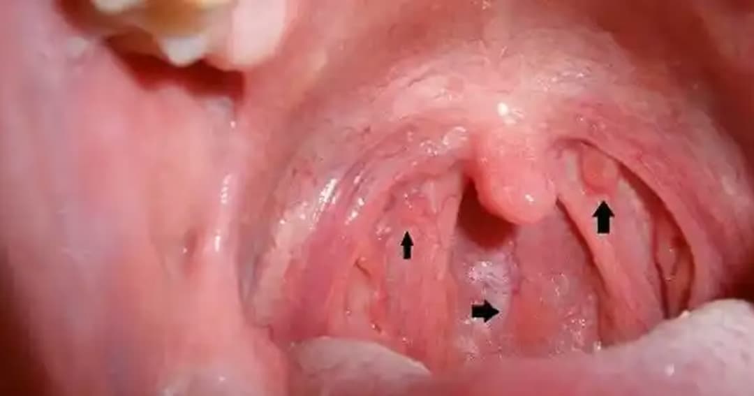 Triệu chứng ung thư vòm họng thường gặp và dấu hiệu cảnh báo sớm