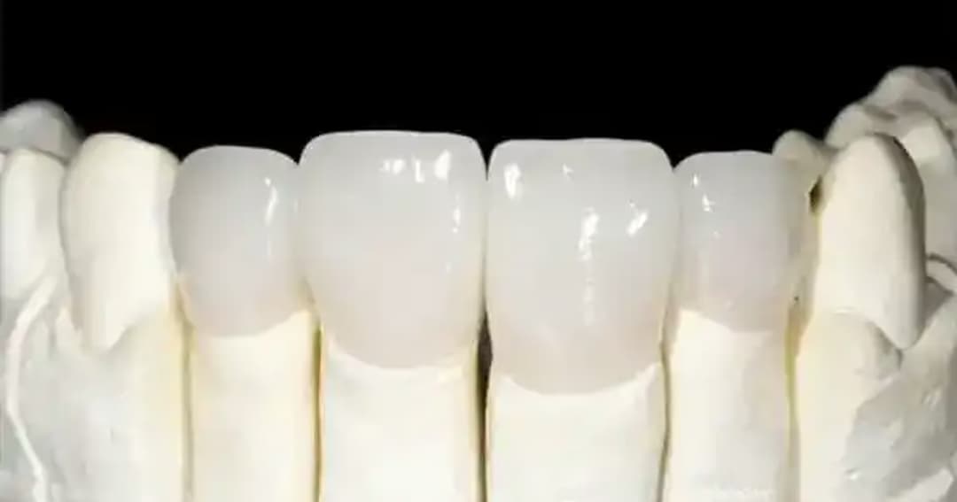Răng toàn sứ Venus Multi: Đặc điểm, ưu điểm và lưu ý khi lựa chọn