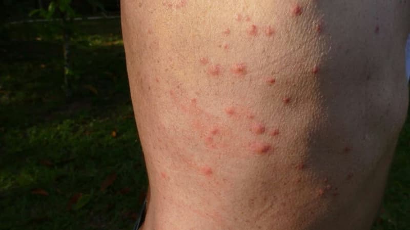 Rệp giường cắn có nguy hiểm không và cách nhận biết, xử lý