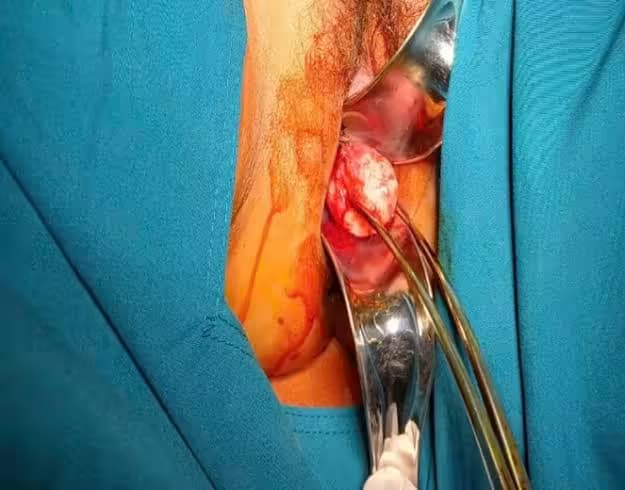 Polyp lòng tử cung: Nguyên nhân, dấu hiệu và cách điều trị
