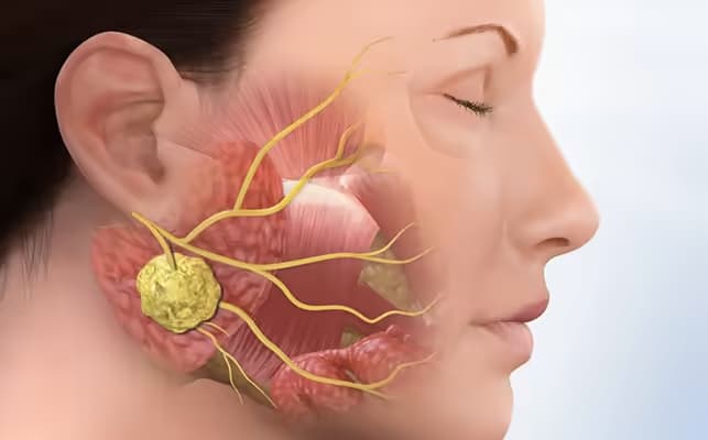 Bệnh quai bị ở nữ giới: Dấu hiệu, biến chứng và cách xử trí y tế
