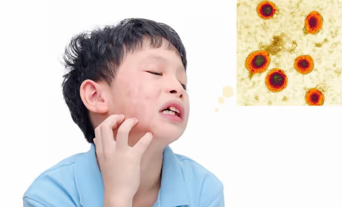 Bệnh quai bị ở trẻ em: Dấu hiệu, biến chứng và cách chăm sóc