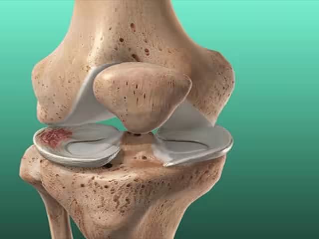 Rách sụn chêm khớp gối: Nguyên nhân, triệu chứng và cách điều trị