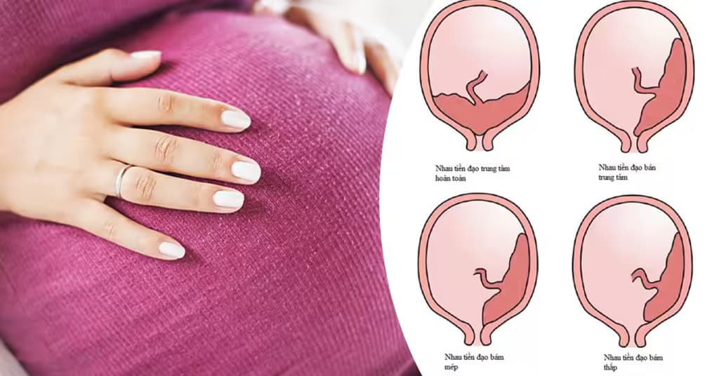 Rau bám mép trong thai kỳ: Dấu hiệu, nguy cơ và cách chăm sóc