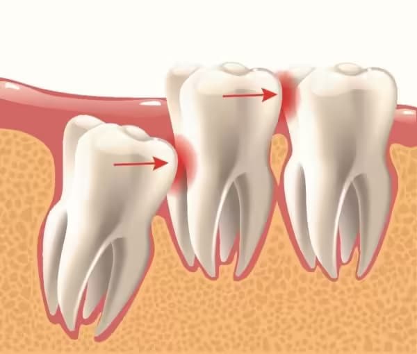 Răng mọc kẹt: Nguyên nhân, dấu hiệu, biến chứng và cách xử trí