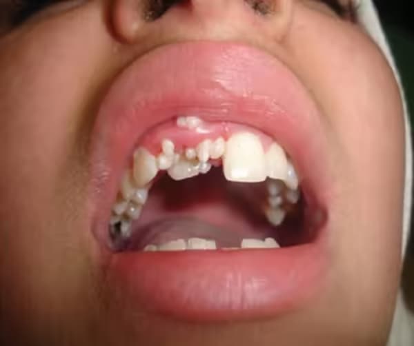 Răng thừa: Nguyên nhân, dấu hiệu và các phương pháp xử trí
