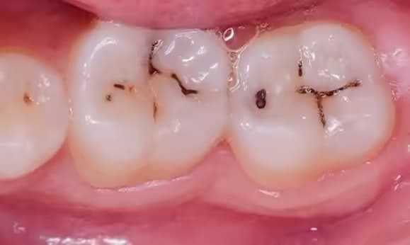 Bệnh sâu răng: Nguyên nhân, dấu hiệu, chẩn đoán và cách điều trị