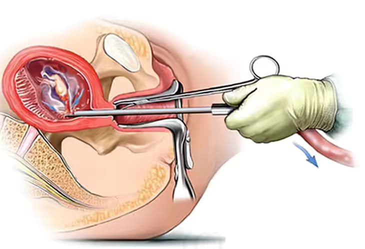 Nạo phá thai: Khái niệm, nguyên nhân, triệu chứng và những rủi ro sức khỏe
