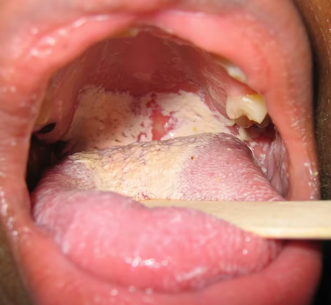 Nấm miệng: Nguyên nhân, dấu hiệu, cách điều trị và phòng ngừa