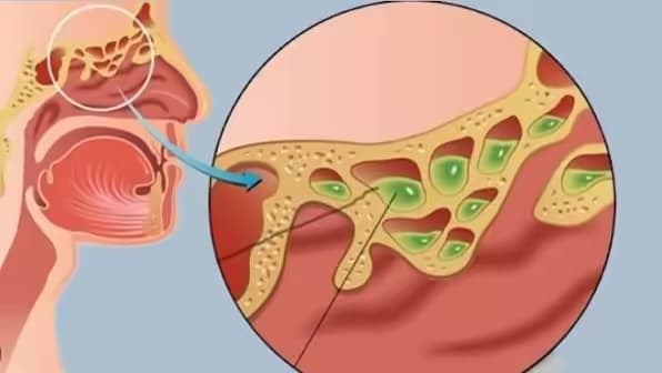 Nghẹt mũi: Nguyên nhân, dấu hiệu và cách chăm sóc