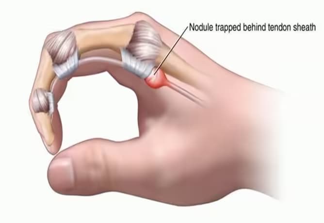 Ngón tay lò xo: Dấu hiệu, nguyên nhân và các cách điều trị