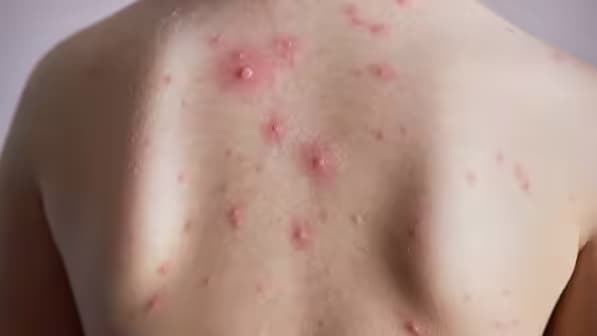 Ngứa da: Nguyên nhân, biến chứng và nguyên tắc xử trí
