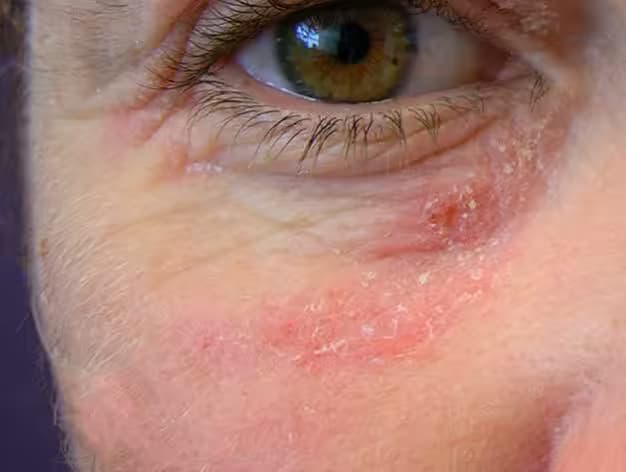 Ngứa mắt: Nguyên nhân, triệu chứng, cách chăm sóc và phòng ngừa