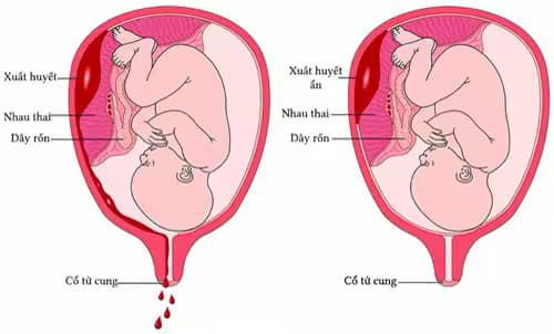 Nhau bong non: Dấu hiệu, nguyên nhân và nguyên tắc xử trí cấp cứu
