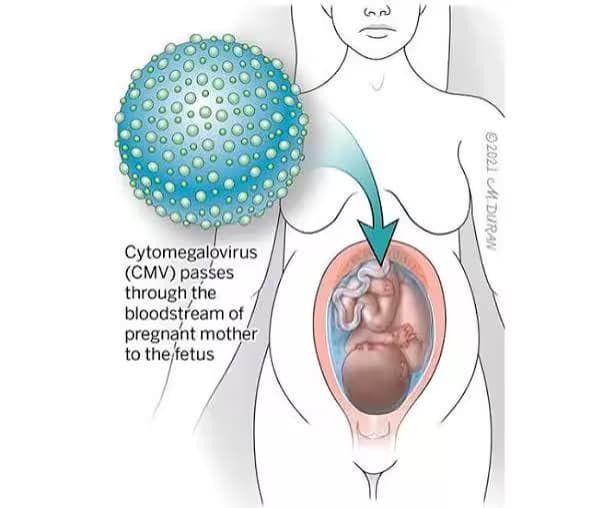 Nhiễm Cytomegalovirus (CMV): Nguyên nhân, triệu chứng và cách xử trí