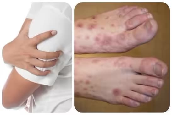 Nhiễm giun chỉ bạch huyết: Nguyên nhân, dấu hiệu và cách điều trị