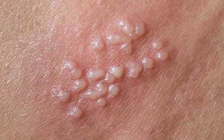Nhiễm virus Herpes simplex: Dấu hiệu, đường lây và cách điều trị