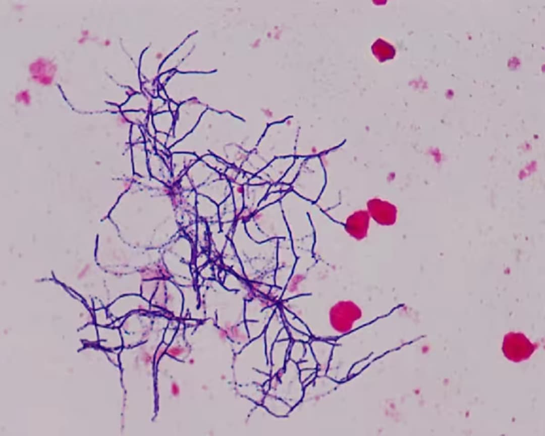 Bệnh nhiễm Nocardia: Nguyên nhân, dấu hiệu, chẩn đoán và cách điều trị