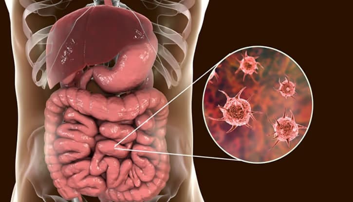 Nhiễm Shigella: Nguyên nhân, triệu chứng, biến chứng và cách xử trí