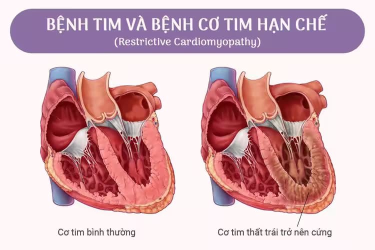 Bệnh cơ tim hạn chế: Nguyên nhân, dấu hiệu và cách điều trị