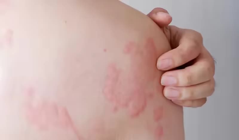 Bệnh dị ứng: Nguyên nhân, dấu hiệu và cách kiểm soát