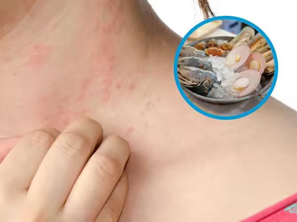 Dị ứng hải sản: Nguyên nhân, dấu hiệu và cách xử trí