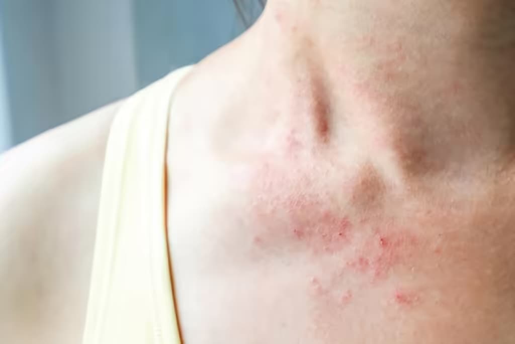 Dị ứng thức ăn: Nguyên nhân, dấu hiệu và cách xử trí