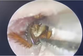 Dị vật trong tai: Dấu hiệu, mức độ nguy hiểm và cách xử trí y tế