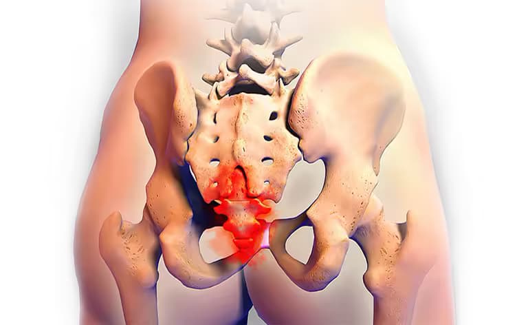 Rối loạn chức năng sàn chậu: Nguyên nhân, dấu hiệu và cách điều trị