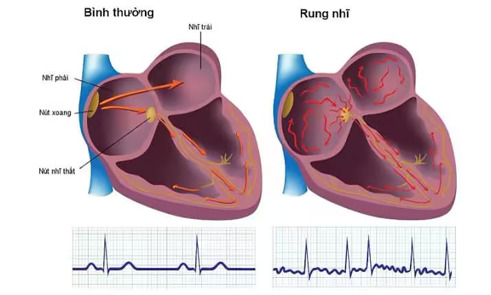 Rung nhĩ: Nguyên nhân, dấu hiệu, biến chứng và cách điều trị