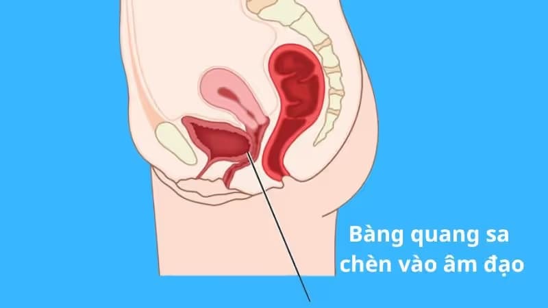Sa bàng quang ở phụ nữ: Nguyên nhân, dấu hiệu và cách điều trị