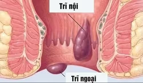 Sa búi trĩ là gì? Nguyên nhân, dấu hiệu và cách xử trí