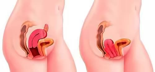 Sa tử cung khi mang thai: Nguyên nhân, dấu hiệu và cách xử trí