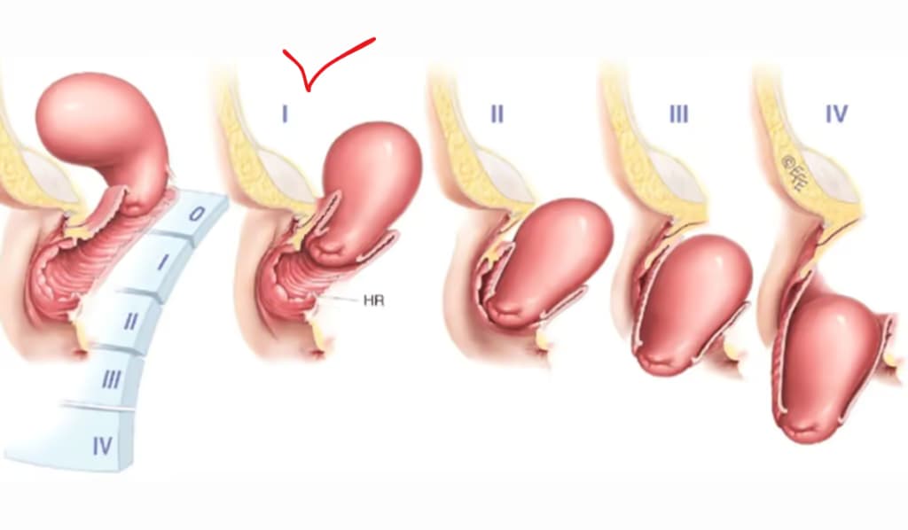 Sa tử cung sau sinh: Nguyên nhân, dấu hiệu và cách điều trị