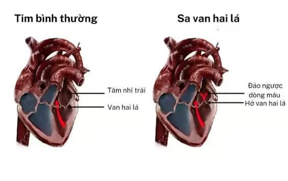 Sa van hai lá: Nguyên nhân, dấu hiệu, biến chứng và cách xử trí