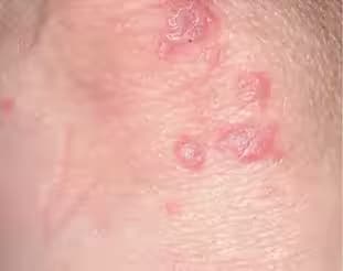 Bệnh sarcoidosis: Nguyên nhân, triệu chứng, chẩn đoán và cách xử trí