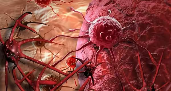 Sarcoma mạch máu: Nguyên nhân, dấu hiệu và cách điều trị