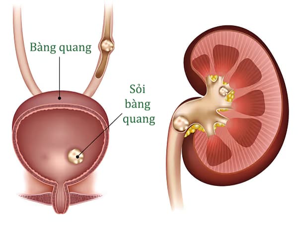 Sỏi bàng quang: Nguyên nhân, dấu hiệu và cách điều trị