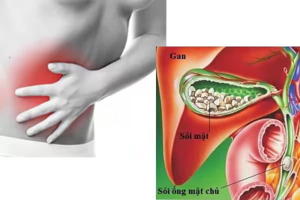 Sỏi ống mật chủ: Nguyên nhân, dấu hiệu và cách điều trị