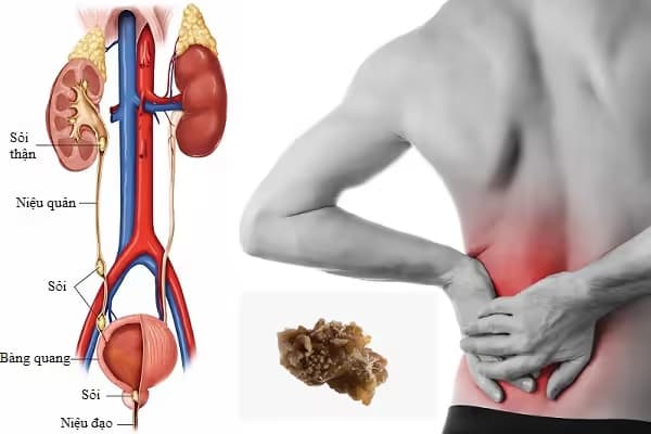 Sỏi tiết niệu: Nguyên nhân, dấu hiệu, biến chứng và cách xử trí